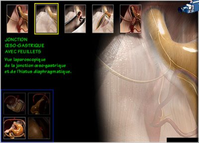 chirurgie digestives  jonction oeuso gastrique avec feuillets